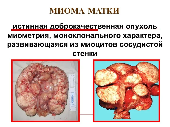 истинная доброкачественная опухоль миометрия, моноклонального характера, развивающаяся из миоцитов сосудистой стенки МИОМА МАТКИ