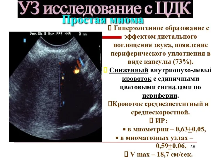 Гиперэхогенное образование с эффектом дистального поглощения звука, появление периферического уплотнения в