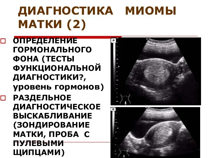 ДИАГНОСТИКА МИОМЫ МАТКИ (2) ОПРЕДЕЛЕНИЕ ГОРМОНАЛЬНОГО ФОНА (ТЕСТЫ ФУНКЦИОНАЛЬНОЙ ДИАГНОСТИКИ?, уровень