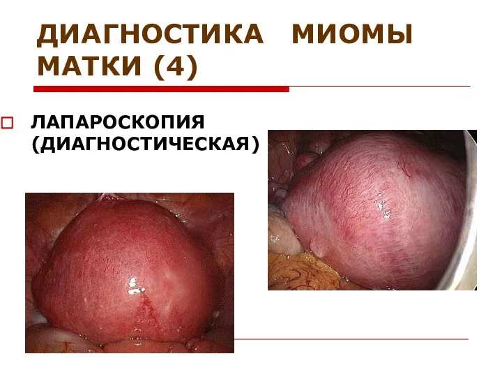 ДИАГНОСТИКА МИОМЫ МАТКИ (4) ЛАПАРОСКОПИЯ (ДИАГНОСТИЧЕСКАЯ)