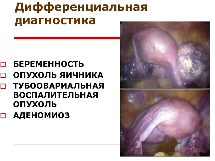 Дифференциальная диагностика БЕРЕМЕННОСТЬ ОПУХОЛЬ ЯИЧНИКА ТУБООВАРИАЛЬНАЯ ВОСПАЛИТЕЛЬНАЯ ОПУХОЛЬ АДЕНОМИОЗ