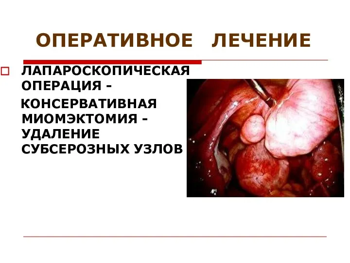 ОПЕРАТИВНОЕ ЛЕЧЕНИЕ ЛАПАРОСКОПИЧЕСКАЯ ОПЕРАЦИЯ - КОНСЕРВАТИВНАЯ МИОМЭКТОМИЯ - УДАЛЕНИЕ СУБСЕРОЗНЫХ УЗЛОВ