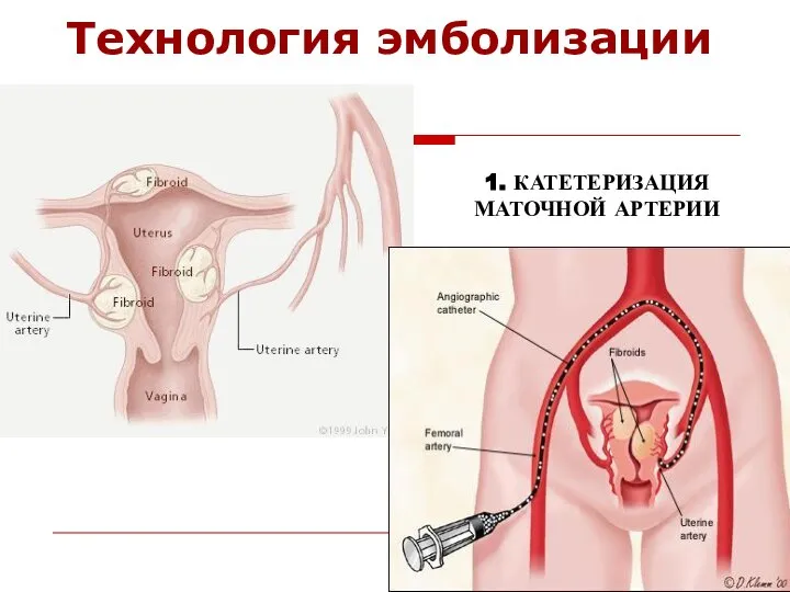 Технология эмболизации 1. КАТЕТЕРИЗАЦИЯ МАТОЧНОЙ АРТЕРИИ