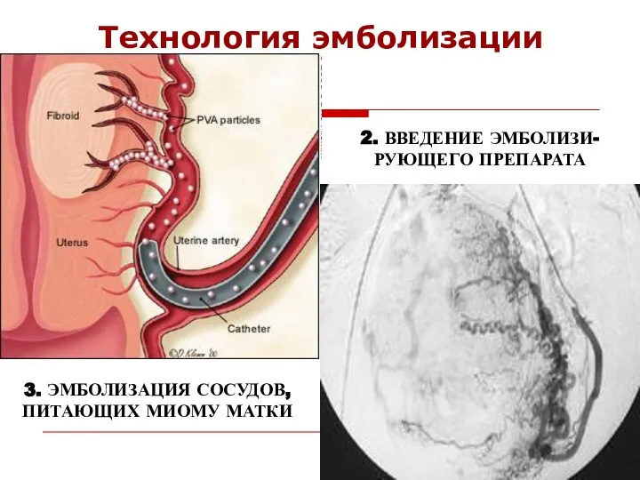 Технология эмболизации 2. ВВЕДЕНИЕ ЭМБОЛИЗИ-РУЮЩЕГО ПРЕПАРАТА 3. ЭМБОЛИЗАЦИЯ СОСУДОВ, ПИТАЮЩИХ МИОМУ МАТКИ