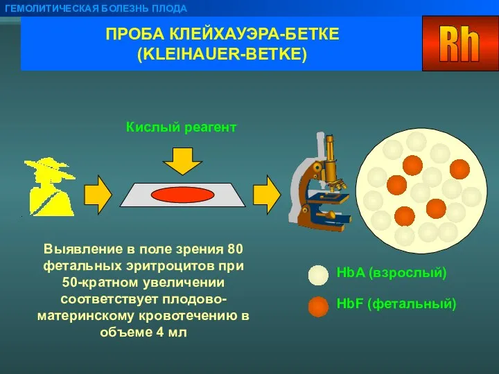 ПРОБА КЛЕЙХАУЭРА-БЕТКЕ (KLEIHAUER-BETKE) ГЕМОЛИТИЧЕСКАЯ БОЛЕЗНЬ ПЛОДА Кислый реагент Выявление в поле