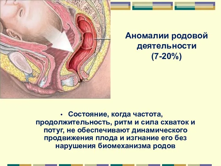 Аномалии родовой деятельности (7-20%) Состояние, когда частота, продолжительность, ритм и сила