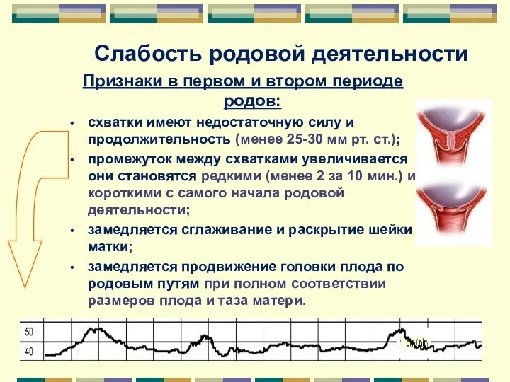 Слабость родовой деятельности Признаки в первом и втором периоде родов: схватки