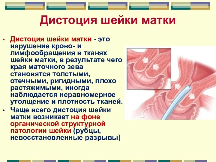 Дистоция шейки матки Дистоция шейки матки - это нарушение крово- и