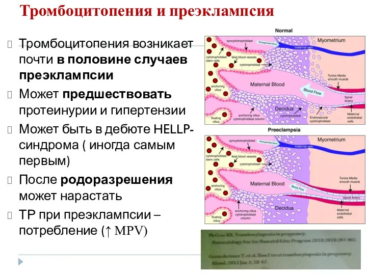 Тромбоцитопения и преэклампсия Тромбоцитопения возникает почти в половине случаев преэклампсии Может