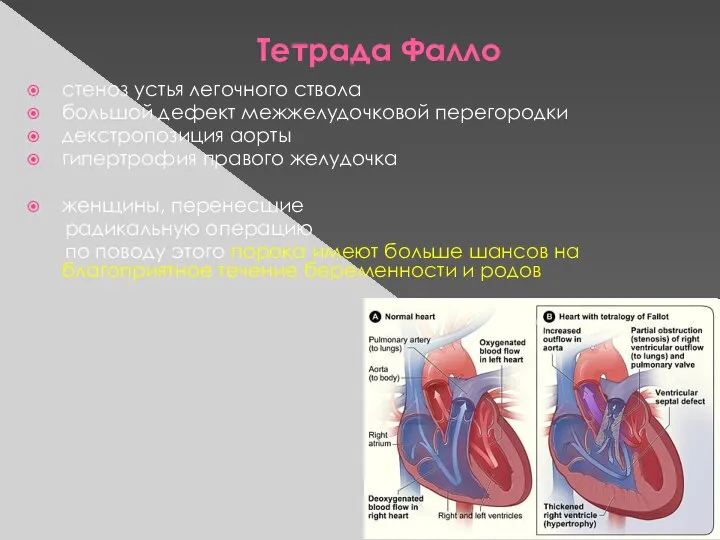 Тетрада Фалло стеноз устья легочного ствола большой дефект межжелудочковой перегородки декстропозиция