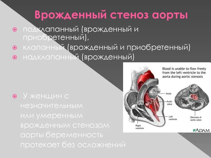 Врожденный стеноз аорты подклапанный (врожденный и приобретенный), клапанный (врожденный и приобретенный)