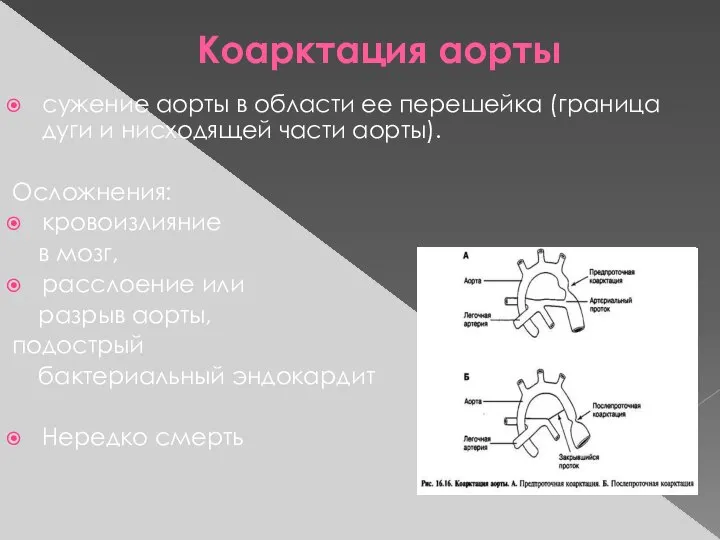 Коарктация аорты сужение аорты в области ее перешейка (граница дуги и