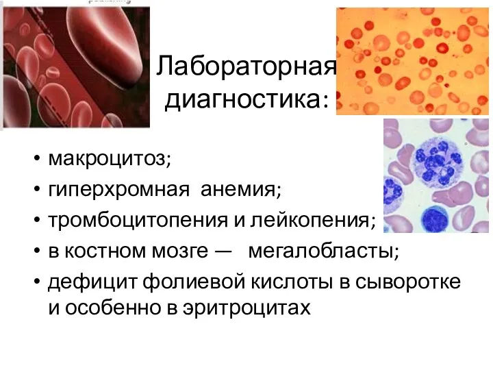 Лабораторная диагностика: макроцитоз; гиперхромная анемия; тромбоцитопения и лейкопения; в костном мозге