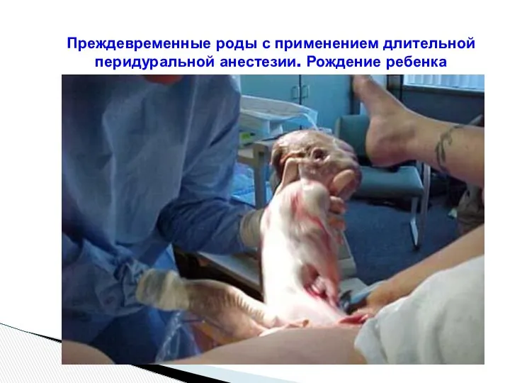 Преждевременные роды с применением длительной перидуральной анестезии. Рождение ребенка