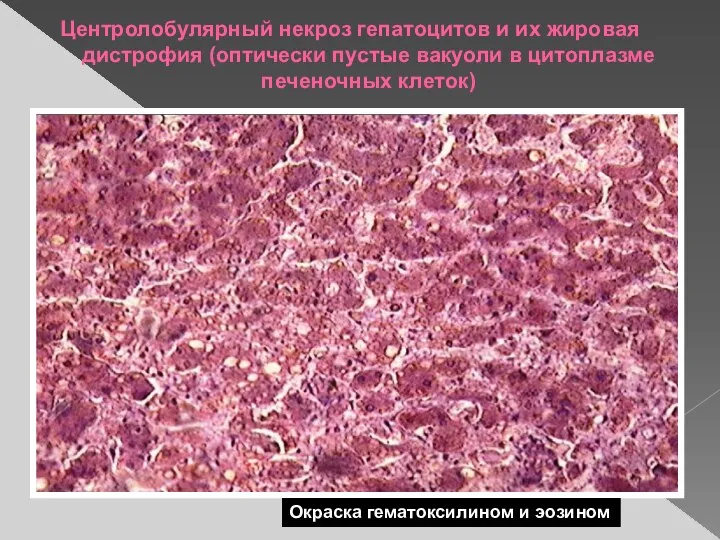 Центролобулярный некроз гепатоцитов и их жировая дистрофия (оптически пустые вакуоли в