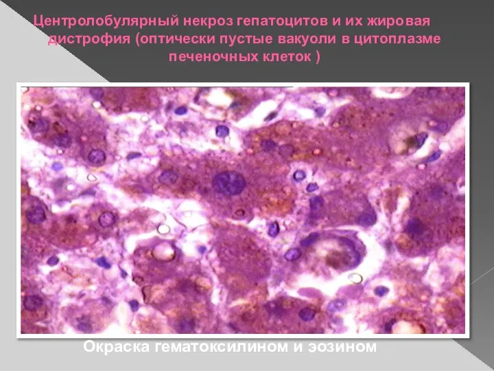 Центролобулярный некроз гепатоцитов и их жировая дистрофия (оптически пустые вакуоли в