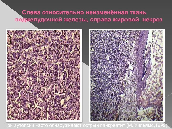 Слева относительно неизменённая ткань поджелудочной железы, справа жировой некроз При аутопсии