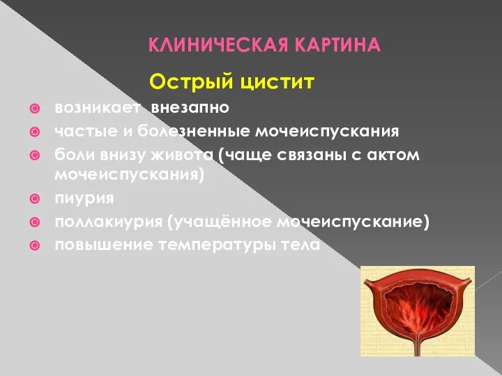 КЛИНИЧЕСКАЯ КАРТИНА Острый цистит возникает внезапно частые и болезненные мочеиспускания боли