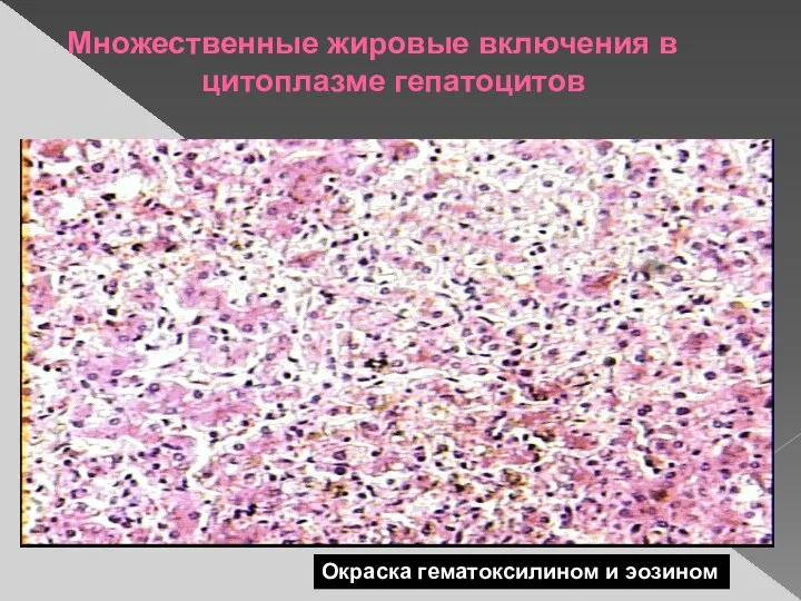 Множественные жировые включения в цитоплазме гепатоцитов Окраска гематоксилином и эозином