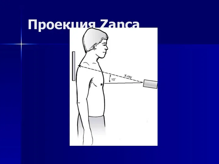 Проекция Zanca