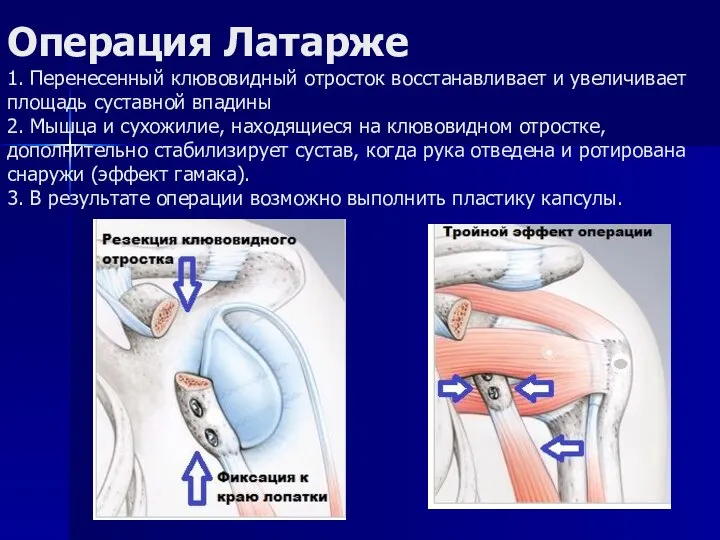 Операция Латарже 1. Перенесенный клювовидный отросток восстанавливает и увеличивает площадь суставной