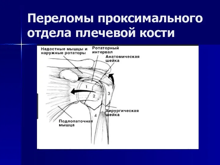 Переломы проксимального отдела плечевой кости