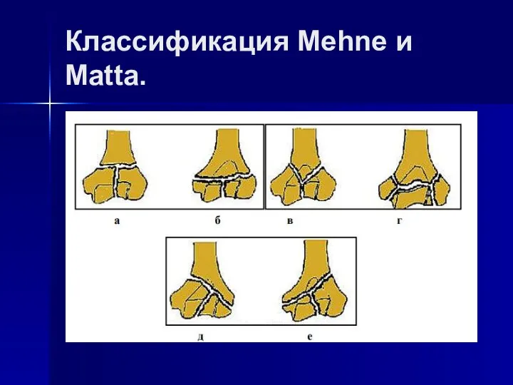 Классификация Mehne и Matta.