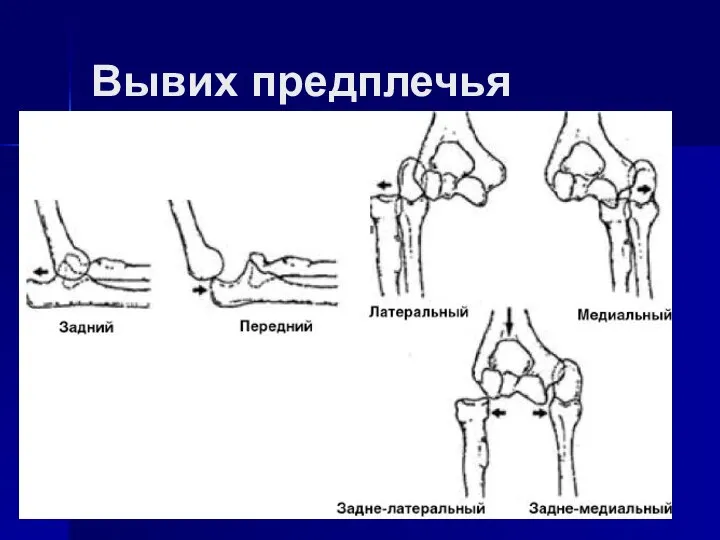 Вывих предплечья