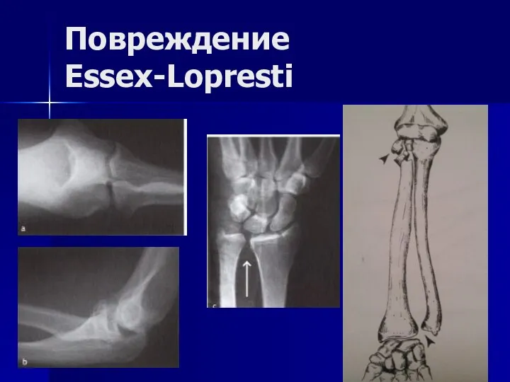 Повреждение Essex-Lopresti