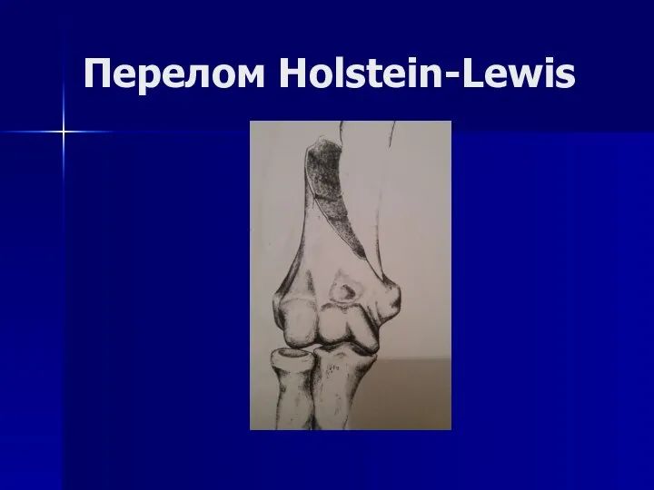 Перелом Holstein-Lewis