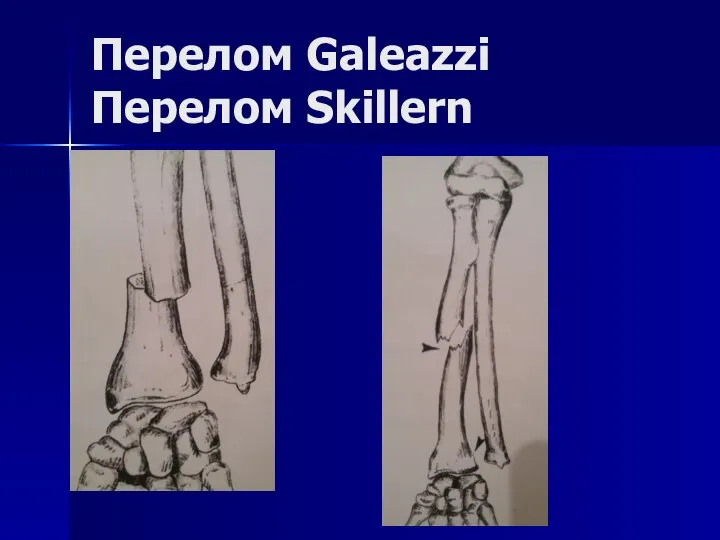 Перелом Galeazzi Перелом Skillern