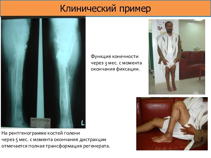 Клинический пример На рентгенограмме костей голени через 5 мес. с момента