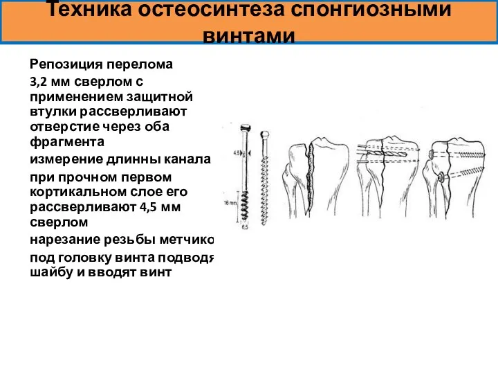 Техника остеосинтеза спонгиозными винтами Репозиция перелома 3,2 мм сверлом с применением