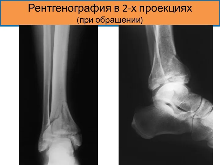 Рентгенография в 2-х проекциях (при обращении)