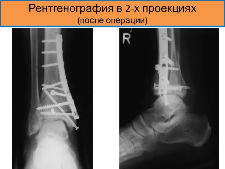 Рентгенография в 2-х проекциях (после операции)