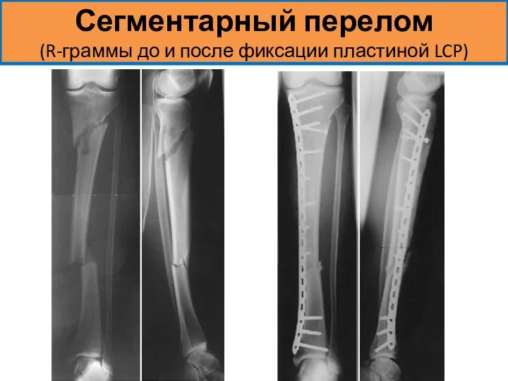 Сегментарный перелом (R-граммы до и после фиксации пластиной LCP)