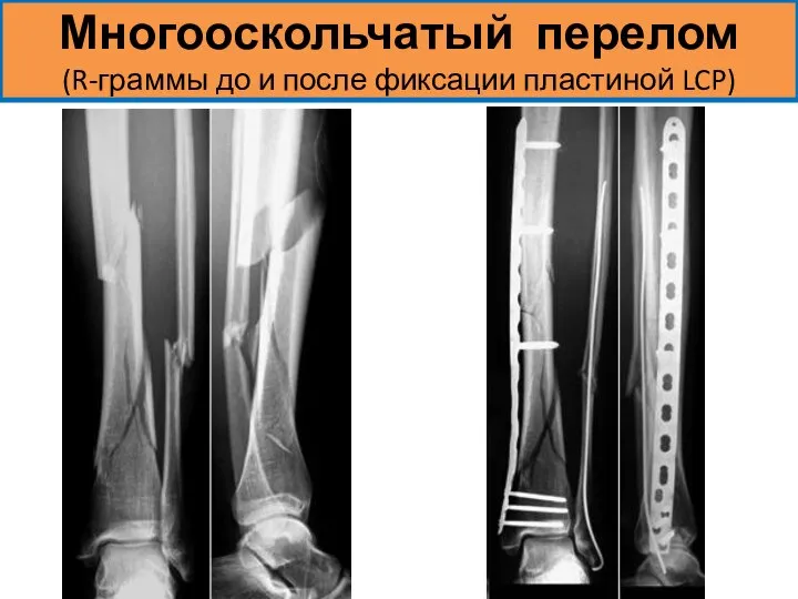 Многооскольчатый перелом (R-граммы до и после фиксации пластиной LCP)