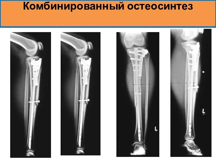 Комбинированный остеосинтез