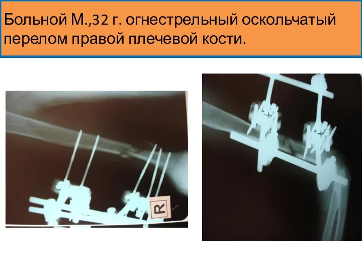 Больной М.,32 г. огнестрельный оскольчатый перелом правой плечевой кости.