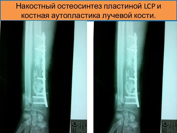 Накостный остеосинтез пластиной LCP и костная аутопластика лучевой кости.