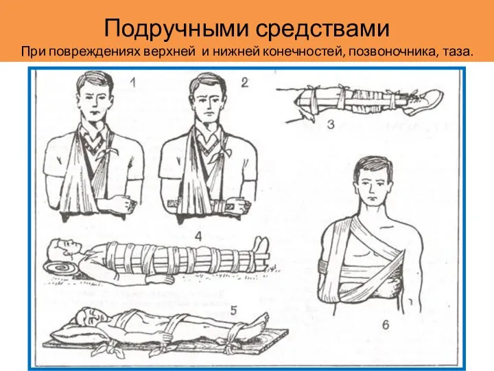 Подручными средствами При повреждениях верхней и нижней конечностей, позвоночника, таза.