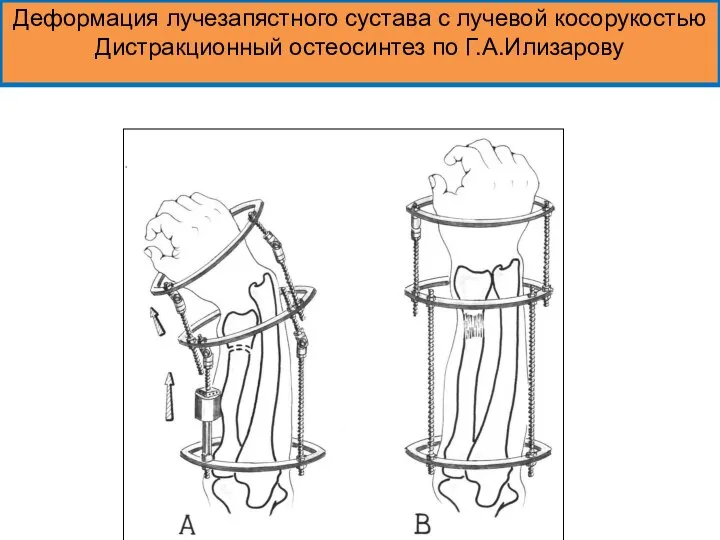 Деформация лучезапястного сустава с лучевой косорукостью Дистракционный остеосинтез по Г.А.Илизарову