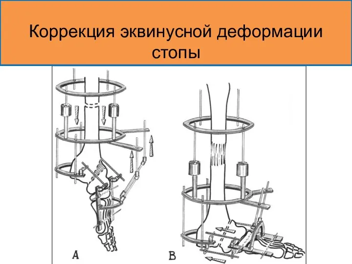 Коррекция эквинусной деформации стопы