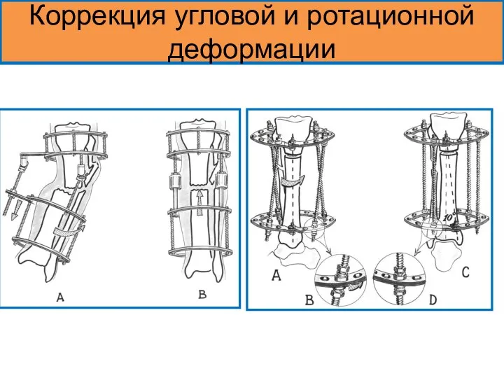 Коррекция угловой и ротационной деформации