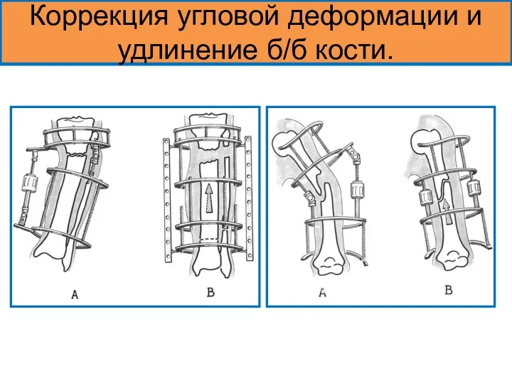 Коррекция угловой деформации и удлинение б/б кости.