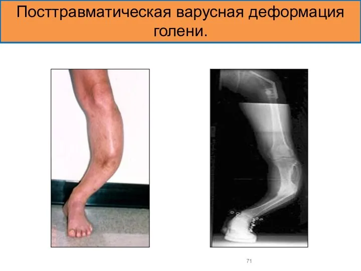 Посттравматическая варусная деформация голени.