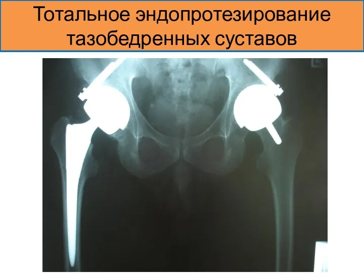 Тотальное эндопротезирование тазобедренных суставов