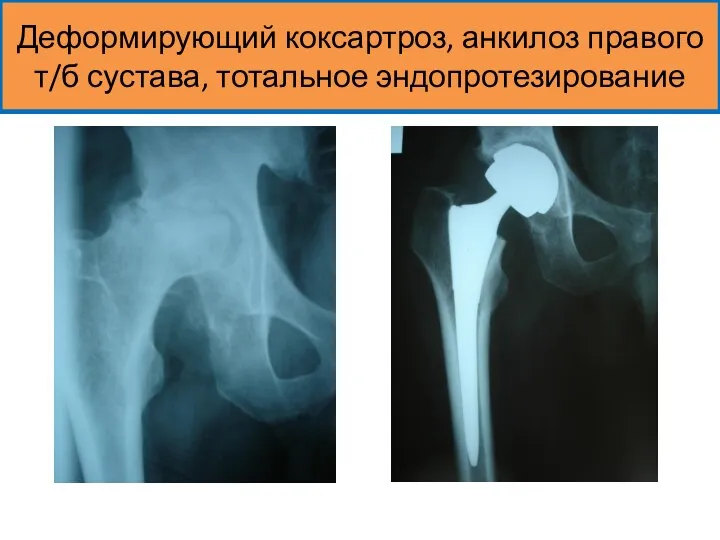 Деформирующий коксартроз, анкилоз правого т/б сустава, тотальное эндопротезирование