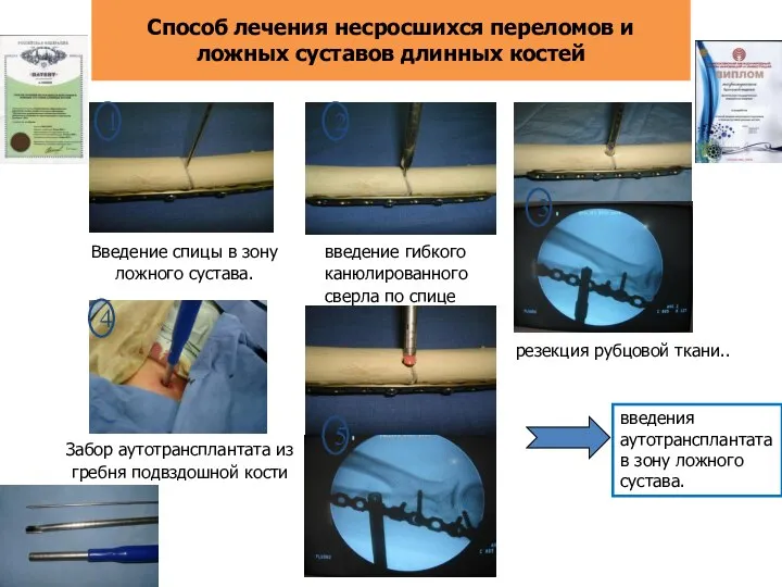 Способ лечения несросшихся переломов и ложных суставов длинных костей Введение спицы