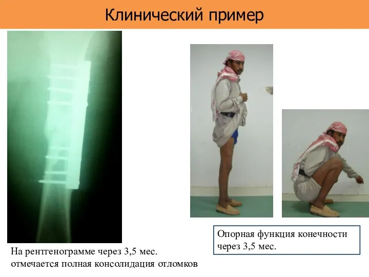 Клинический пример Опорная функция конечности через 3,5 мес. На рентгенограмме через